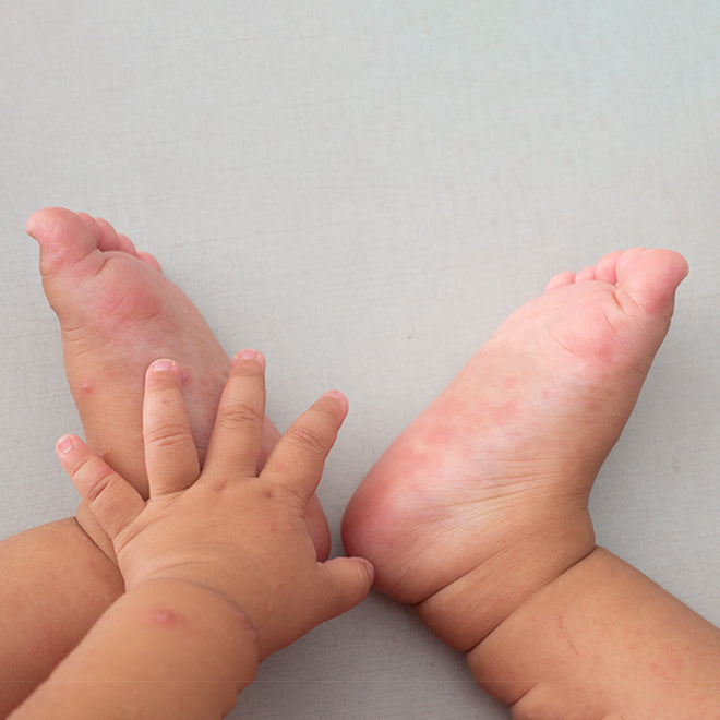Hand, foot & mouth disease in children: All you need to know